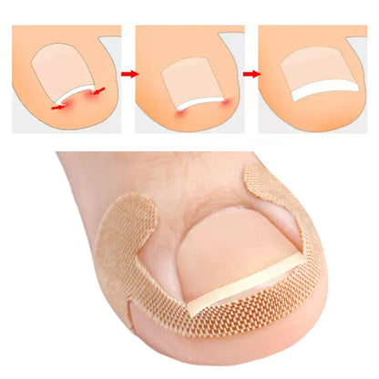Toenail Correction Strips