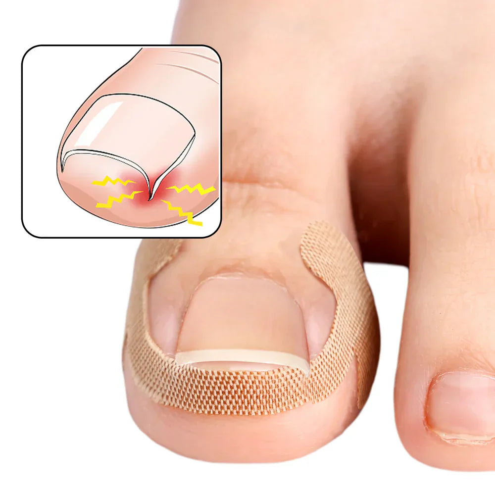 Toenail Correction Strips