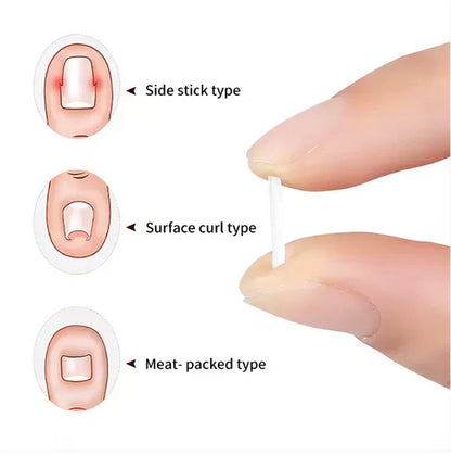 Toenail Correction Strips
