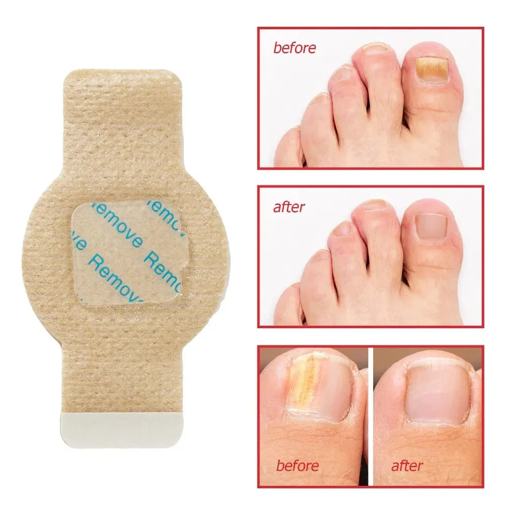 #1 Fungal Nail Patches